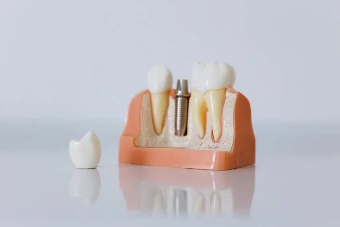 What is a dental implant?